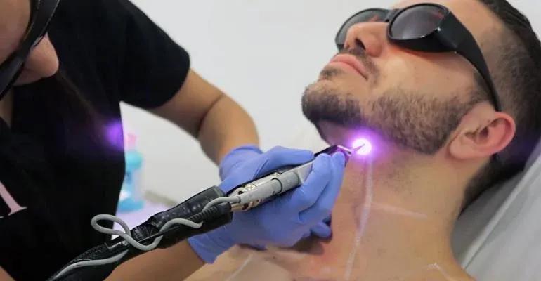 Laser Hair Removal Precision Procedure